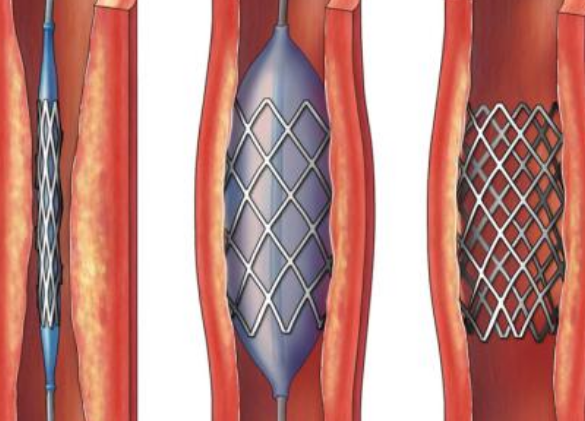 好消息！700元冠脈支架來了帶量采購結果在甘肅省正式落地執(zhí)行